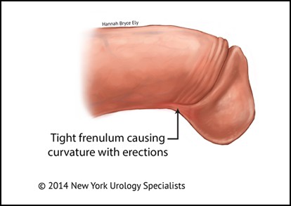 Frenulum breve urologist for frenuloplasty on penis frenulum